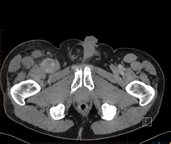 Figure 1 for case Vascular leiomyosarcoma ( RID4387 )